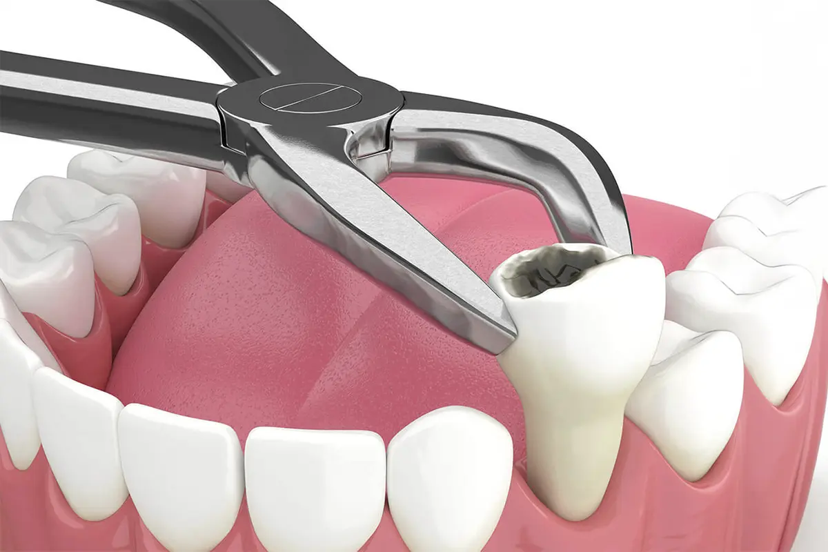 TOOTH EXTRACTIONS