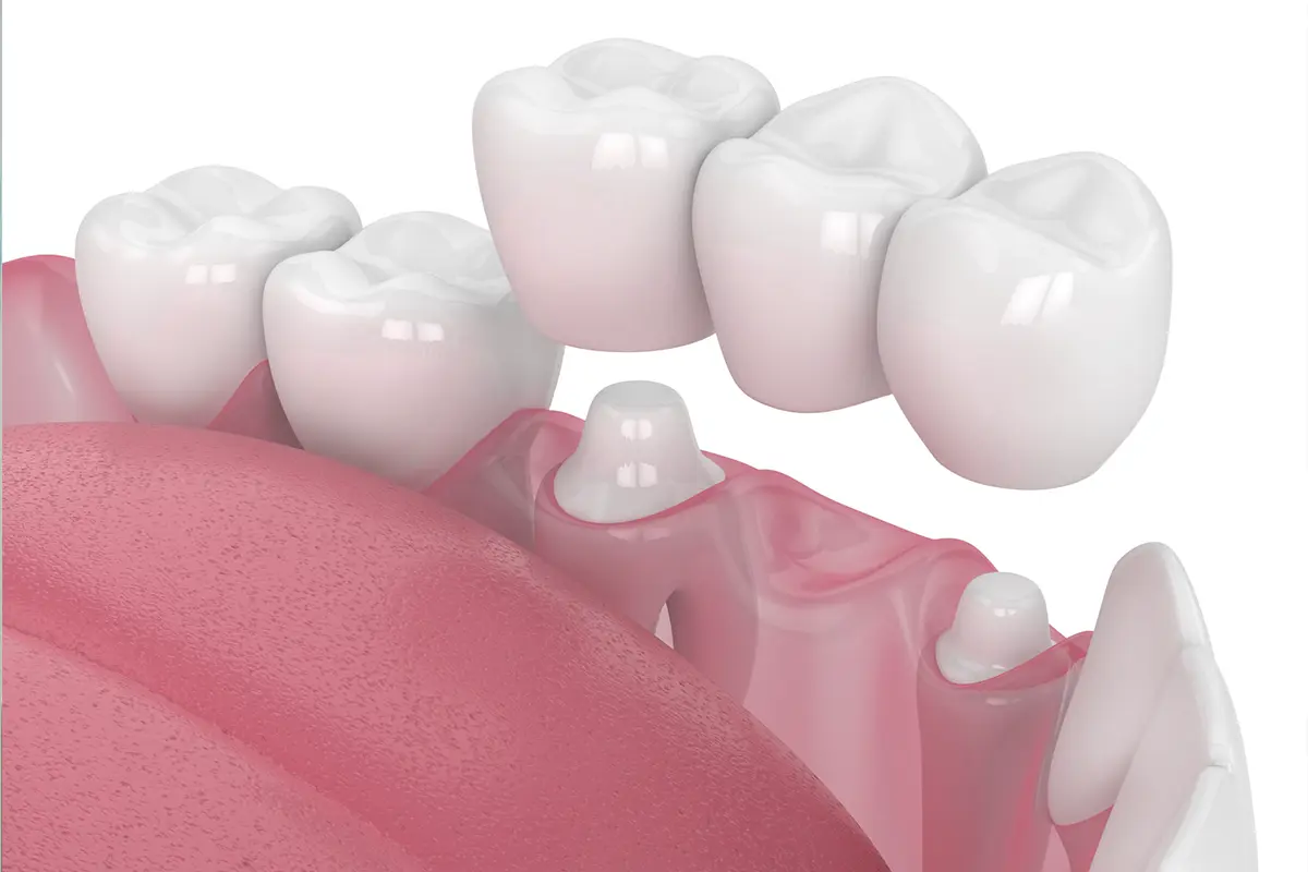 DENTAL CROWNS AND BRIDGES