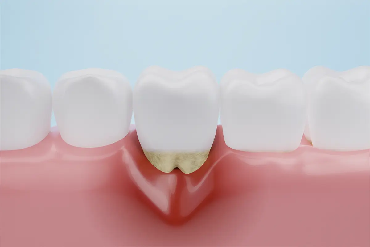 GUM DISEASE TREATMENT