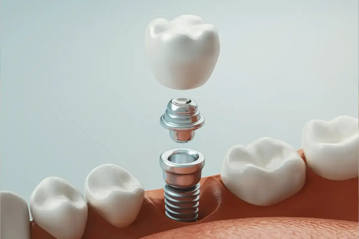 DENTAL IMPLANTS