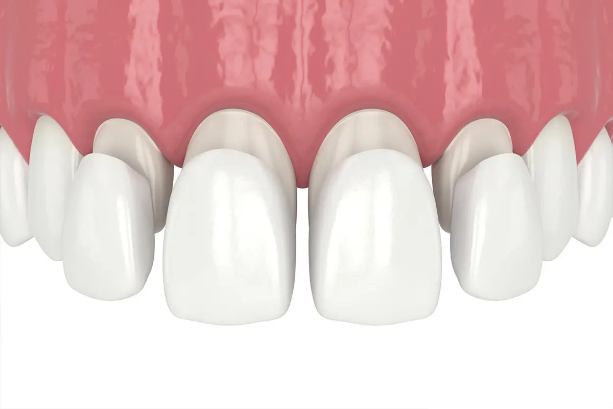 DENTAL VENEERS