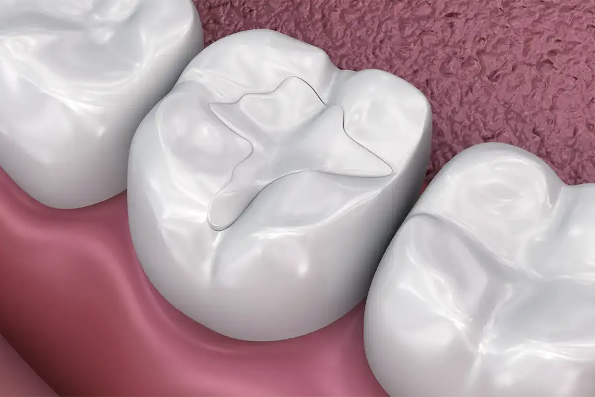 TOOTH FILLINGS AND SEALANTS