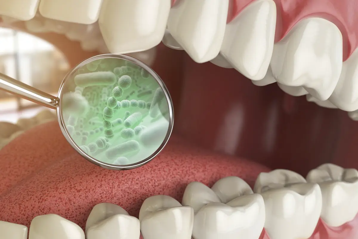 HALITOSIS (BAD BREATH) TREATMENT