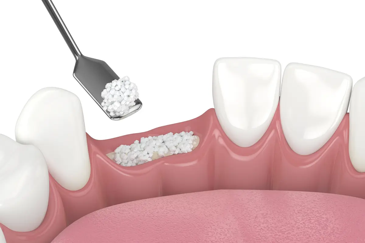 DENTAL BONE GRAFTING