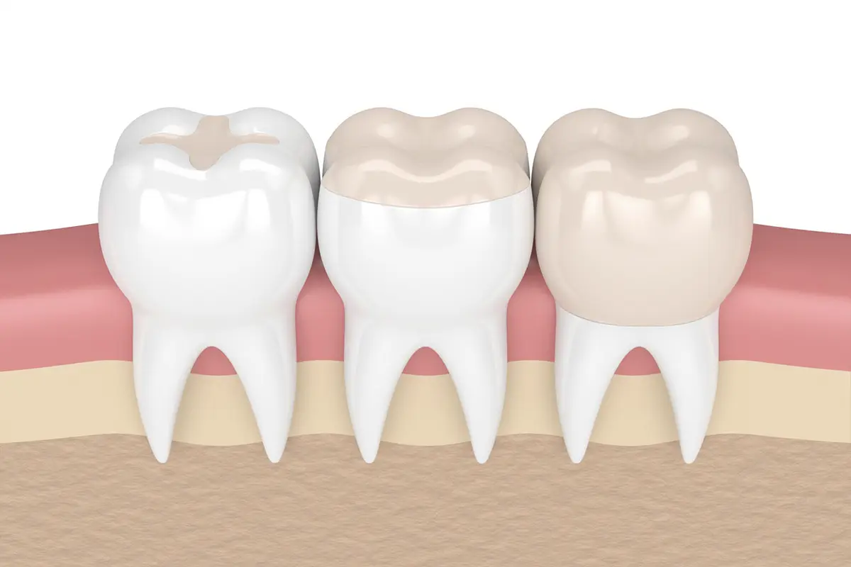 DENTAL INLAYS AND ONLAYS