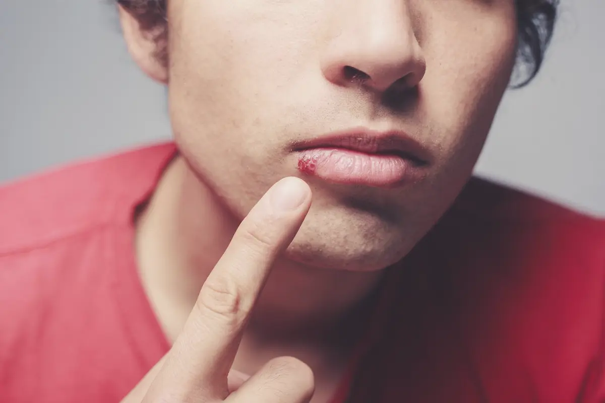 COLD SORE TREATMENT