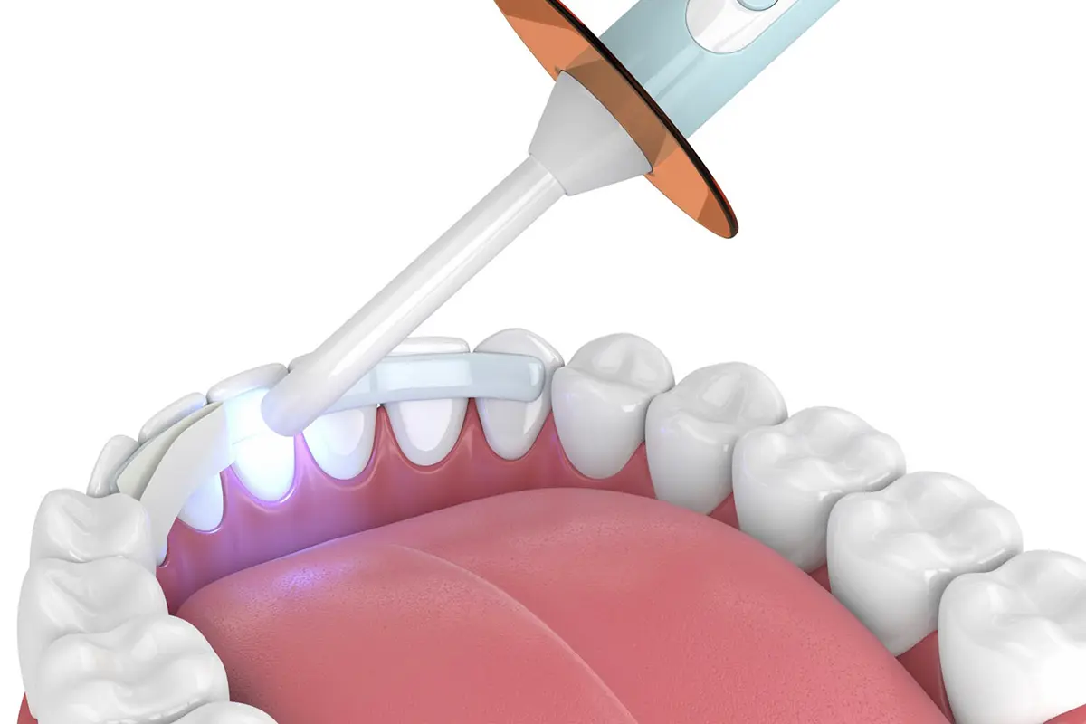 DENTAL BONDING
