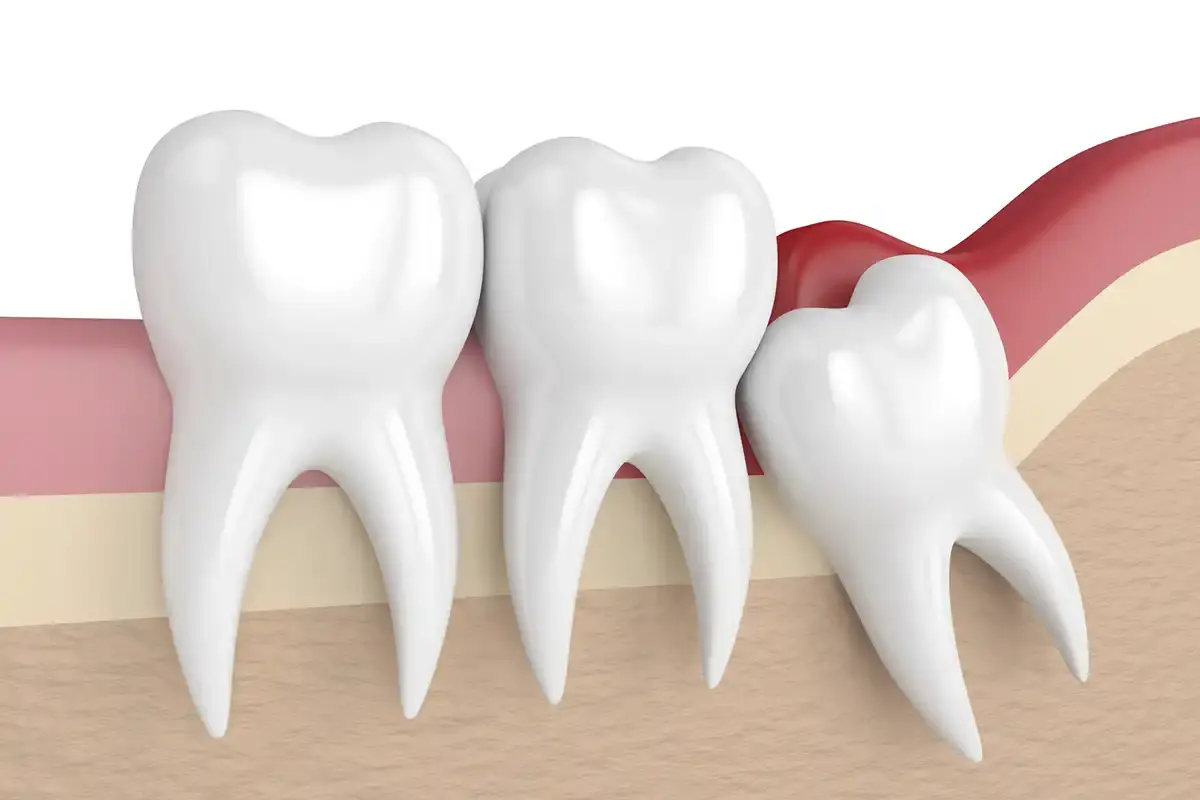 WISDOM TEETH REMOVAL