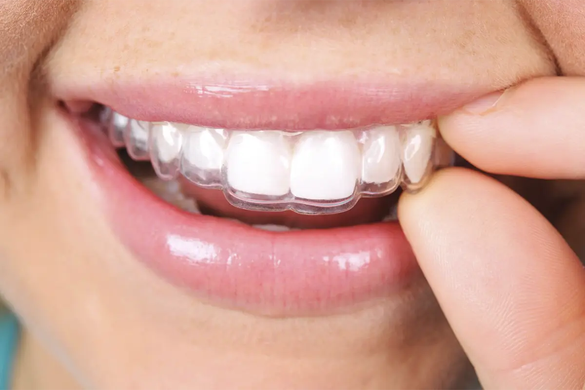 CLEAR ALIGNERS
