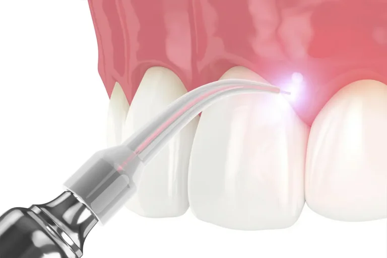 Soft-tissue laser technology illustration