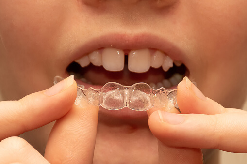 Dental Patient with Teeth Gap Using Clear Aligners